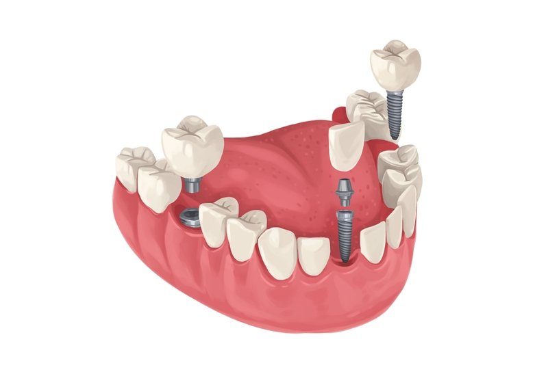 When can I vape after wisdom teeth removal?